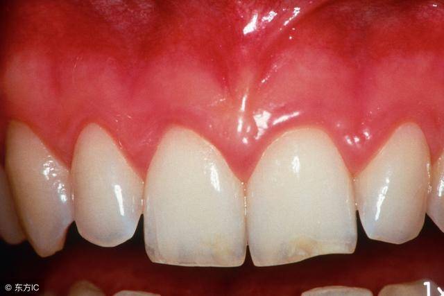 牙龈问题与癌症有着千丝万缕的关系!