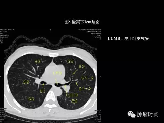 经典中的经典:胸部 ct 断层,肺叶分段,各组淋巴结划分