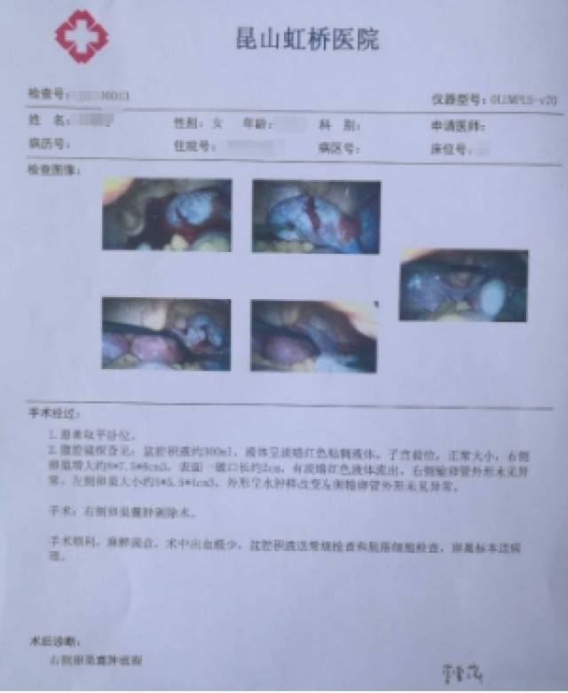 生死攸关,昆山虹桥医院妇科争分夺秒抢救卵巢囊肿破裂