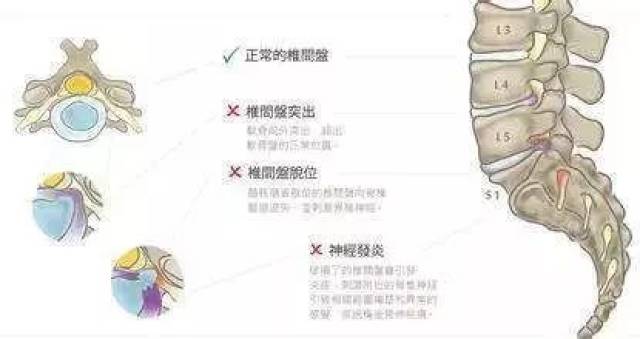 腰痛常见疾病及康复训练图解