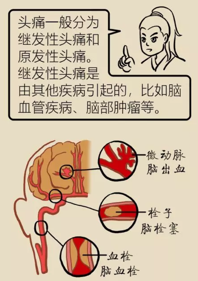 偏头痛发病,究竟是哪些原因导致?