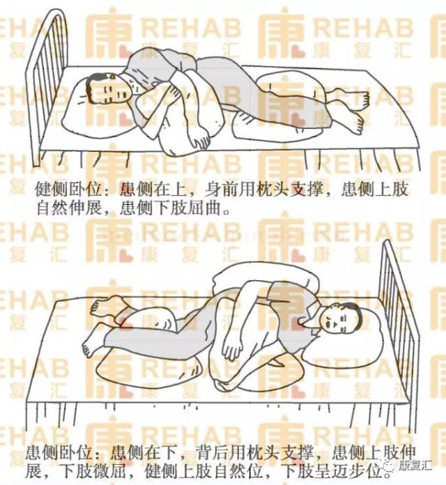 双下肢间垫一枕头,患侧骨盆旋前,髋,膝关节呈自然半屈曲位,置于枕上.