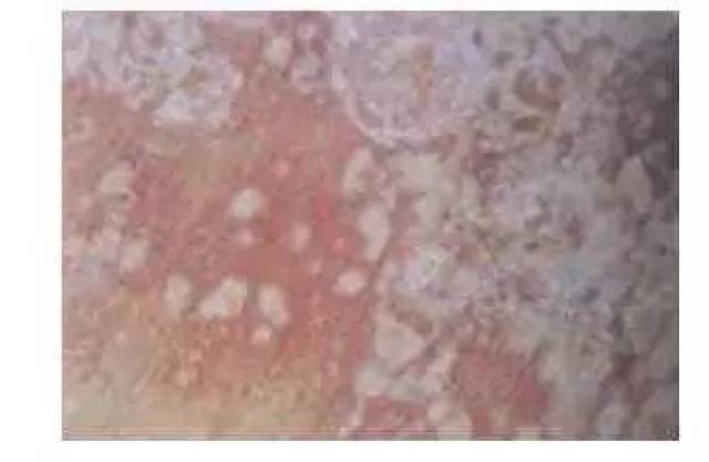皮损分布于肛门及周围皮肤(图4),长期搔抓可见肛门肥厚,皲裂,浸渍
