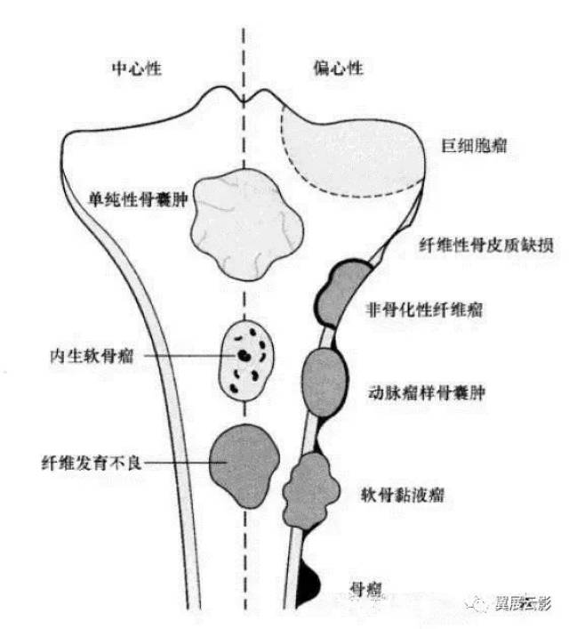 一图掌握常见骨肿瘤的好发部位和影像学特点