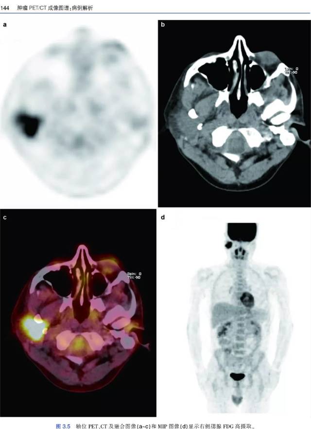 131个病例,教你玩转肿瘤pet/ct!