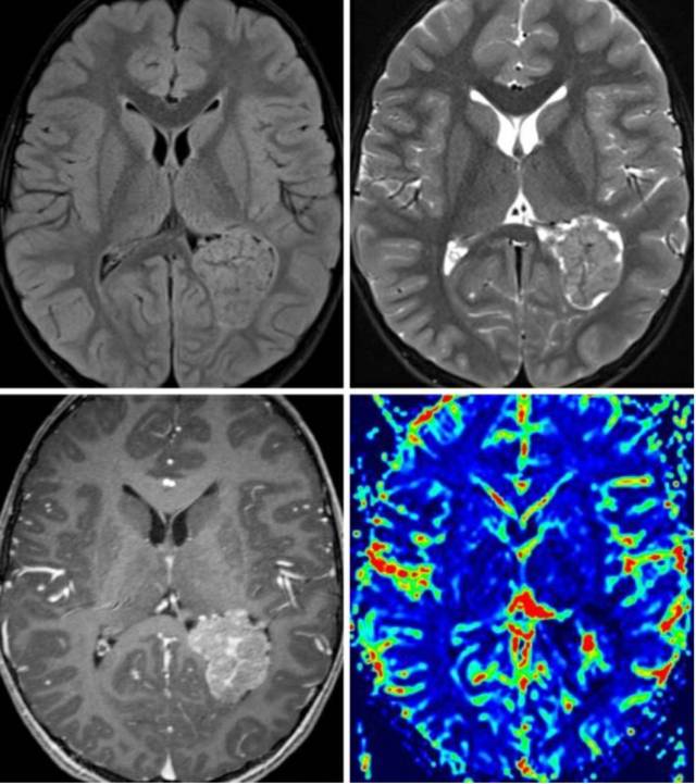 脉络丛乳头状瘤(cpp)的影像学特征 | the neurosurgical atlas全文