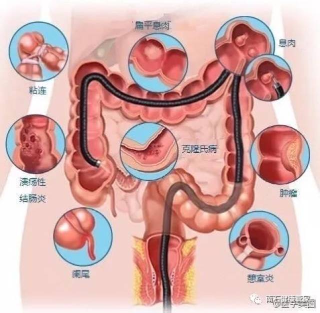 结直肠癌的发生是一个长期的过程,一般从息肉再到异型增生再到癌变.