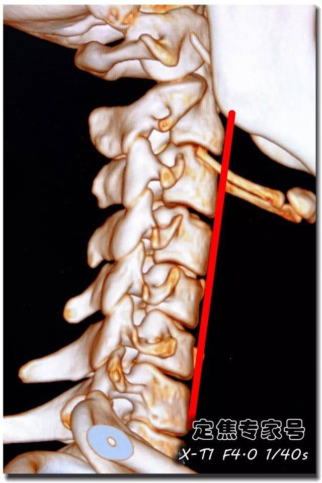 这是一个14岁湖北女孩莉莉的颈椎片子,我们看到她的颈椎几乎是一根直