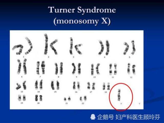 但是发现了其他异常 l xo/xx特纳综合征mosaic tuner syndrome(mos