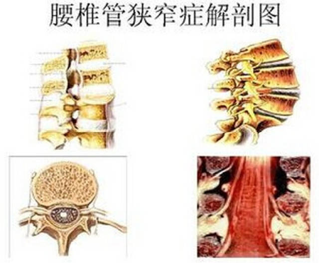 1975～1977年verbiest根据椎管中央矢状径(m-s径)和椎管椣径的测量将