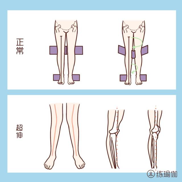 本来髋外旋是会出现o型腿问题的, 可是蒋欣的  髋外旋 膝盖超伸, 就