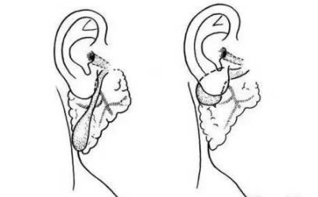 前的几个月,由于胚胎发育期构成耳廓的组织发育不全引起的耳前瘘管,它