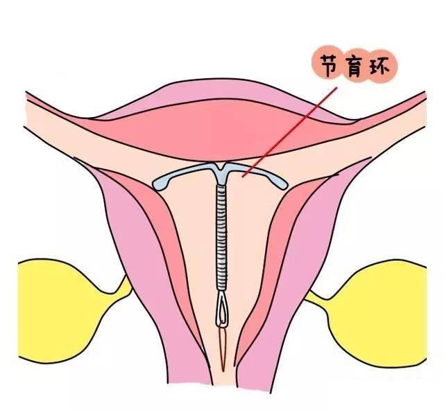 上环时间长了需要取掉吗？看看医生怎么说
