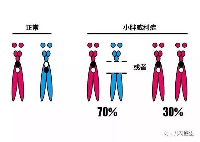 正规的名字叫prader-willisyndrome(prader-willi综合征),简称pws