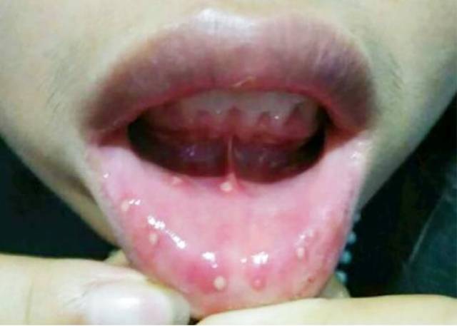 有种撕心裂肺的痛叫"嘴巴长疮",嘴里常含1植物,3天就治好
