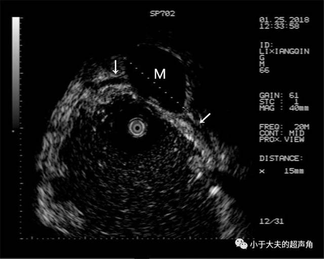 图5:超声胃镜进一步确认这枚结节是胃壁家的"孩子",突向浆膜侧,结节