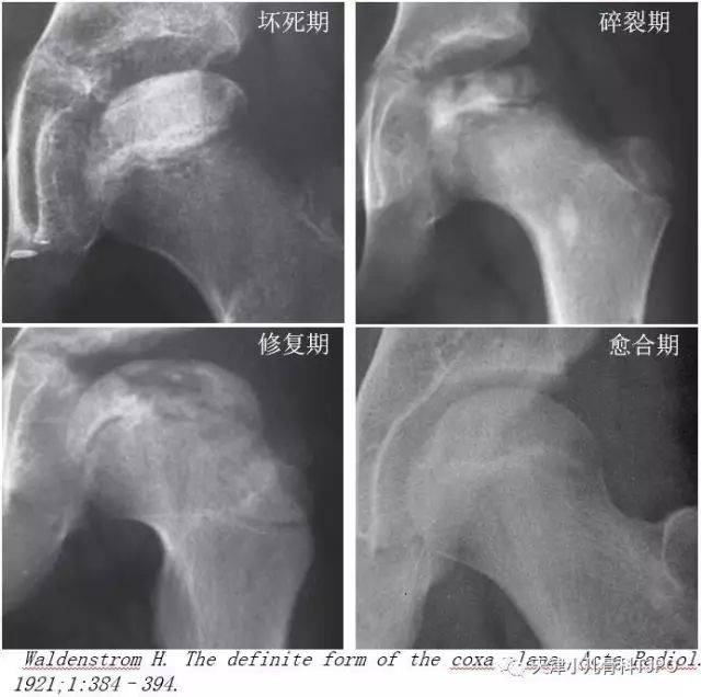 (perthes病)儿童股骨头坏死---改良waldenstrom分期