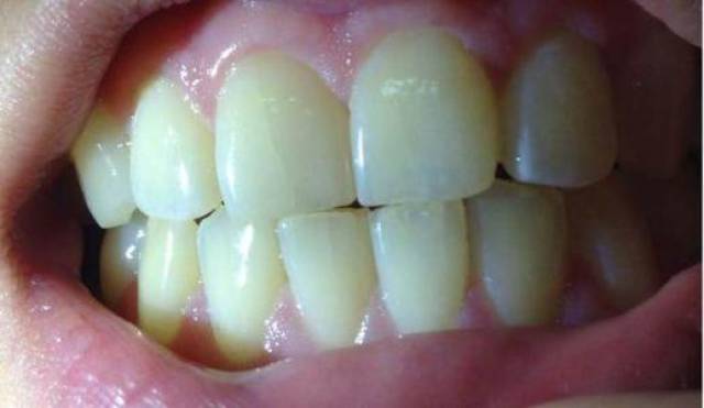 你是否每天都有效护理牙齿?教你自测口腔健康!