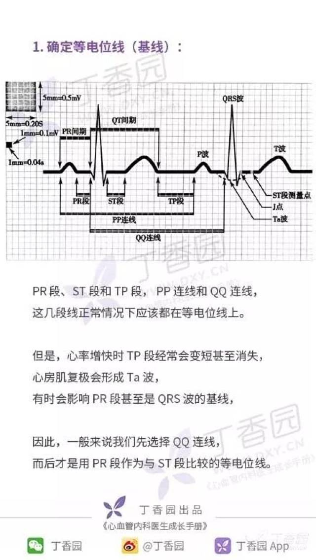 查房必备|心电图 st 段改变究竟怎么读?