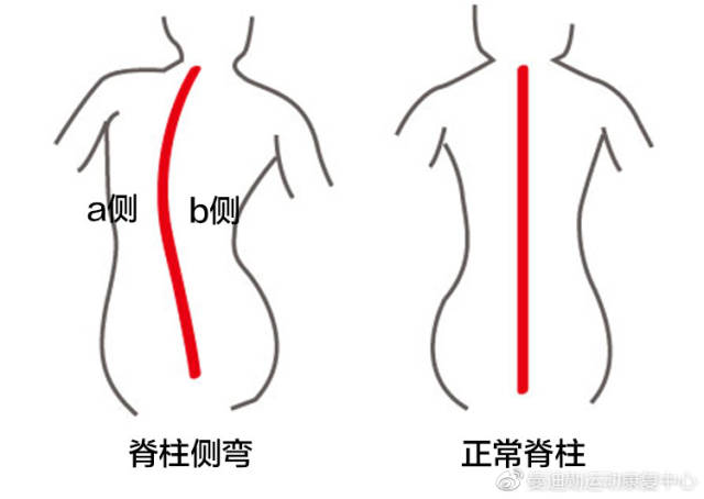 s型脊柱侧弯锻炼方法图?