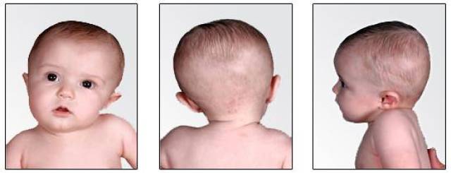 4,病情发展下去,还会导致宝宝的面部不对称(即大小脸).