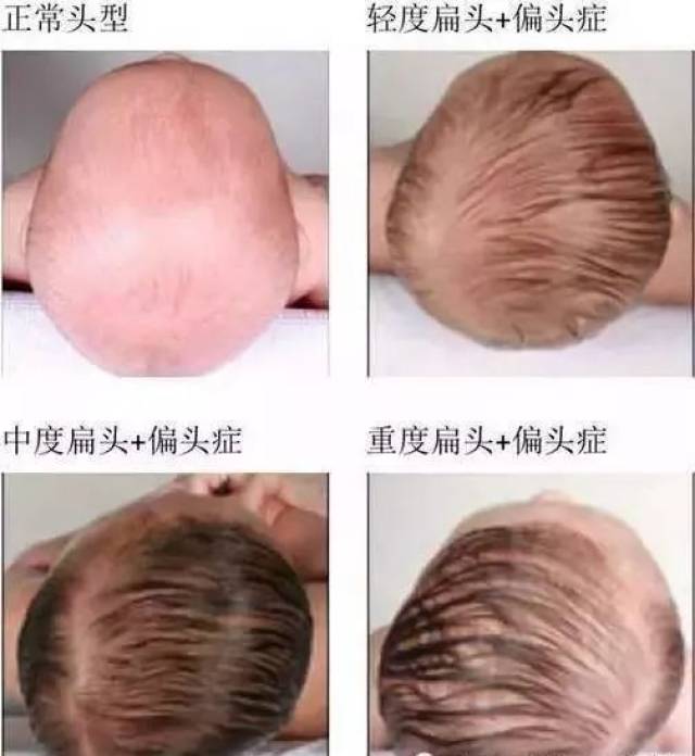 小婴儿需要用枕头吗?