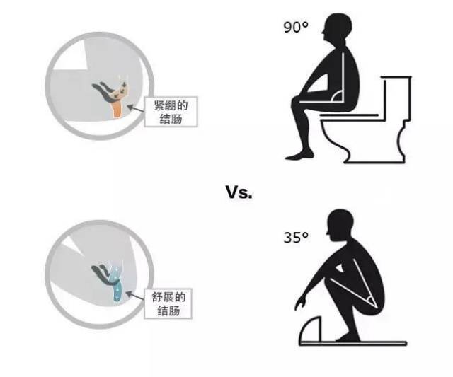 外国 科学家说:蹲式姿势可以让消化系统末端保持自然角度,排便更顺畅