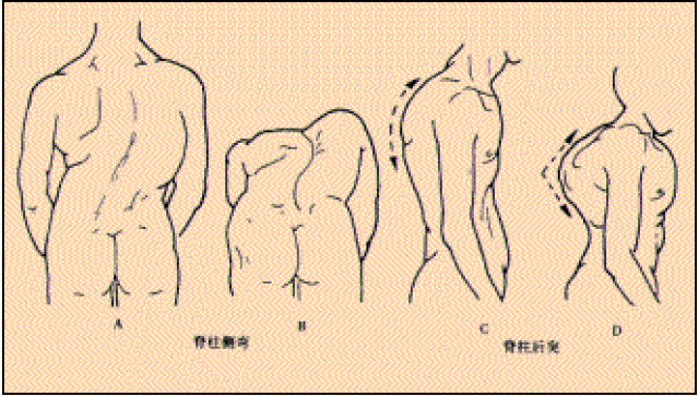 身体有点鸡胸,怎么通过健身改善?