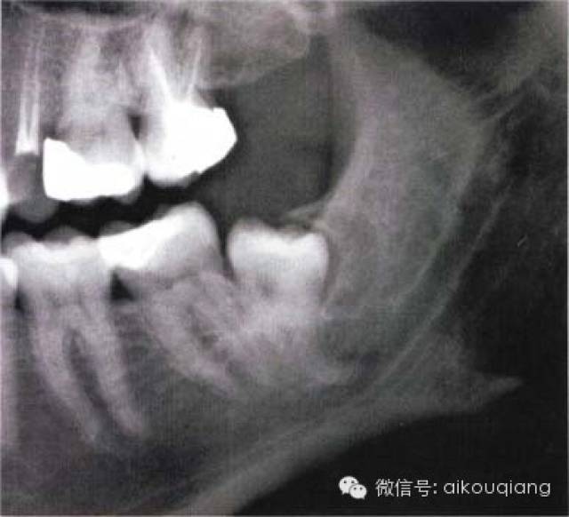 口腔麻醉-拔牙术-阻生牙拔除
