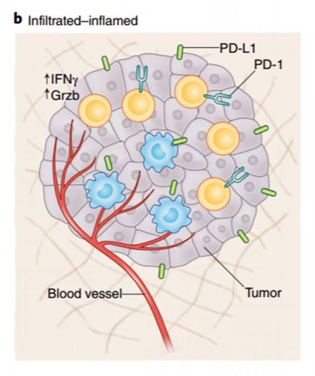 infiltrated–inflamed(i-i times)