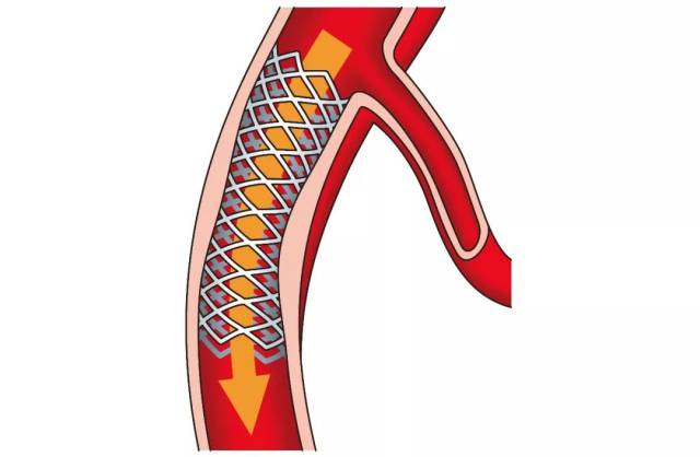 第984期|心脏支架怎么选?听听专家大实话!