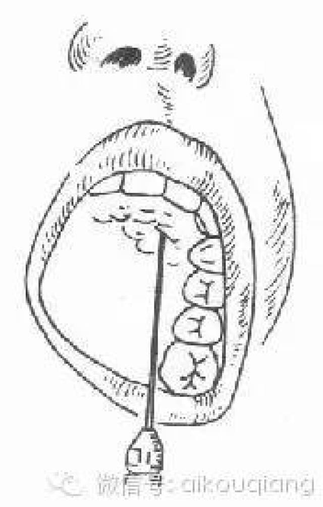 图5～2 上颌结节注射 腭前神经阻滞麻醉 (腭大孔注射):见图5～3.