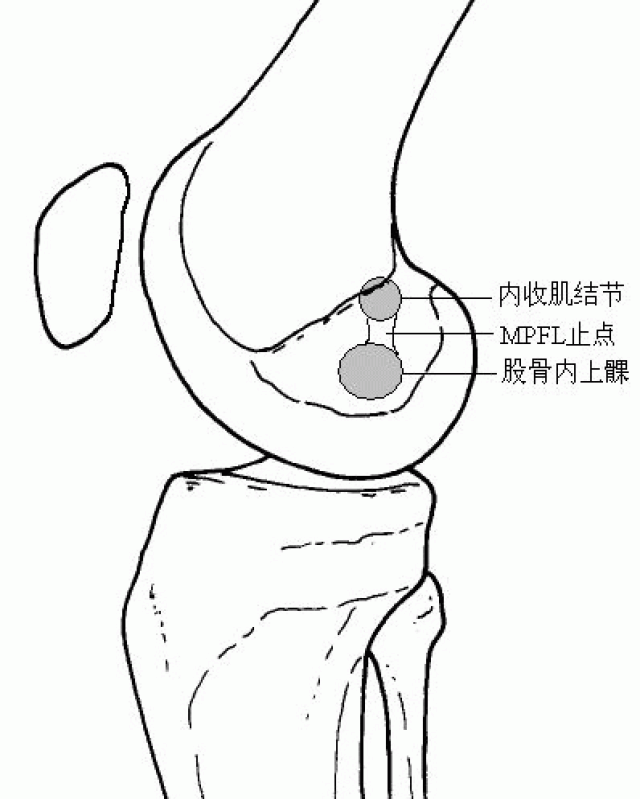 髌骨脱位可以不做手术吗