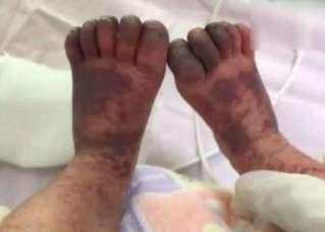 广东东莞未满月女婴在家中被老鼠咬伤, 感染病毒全身发紫, 生命垂危!