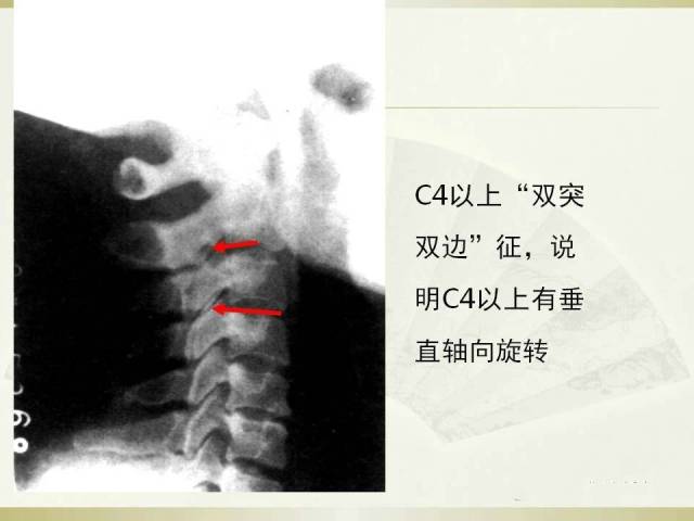 颈椎病的影像学诊断及临床分型汇总