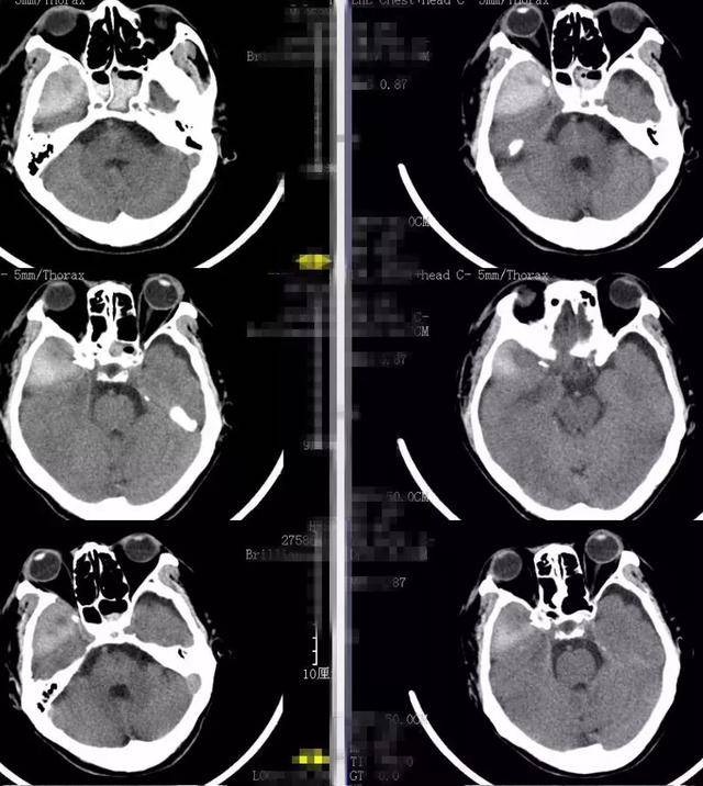 2018-1-22及2018-1-27再次复查头颅ct显示右颞硬膜外血肿较前逐渐