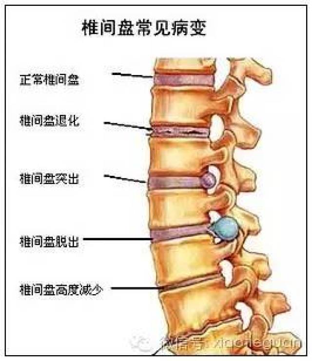 首先我们来看看椎间盘是什么,图片腰椎之间这扁扁的一小块就是椎间盘.