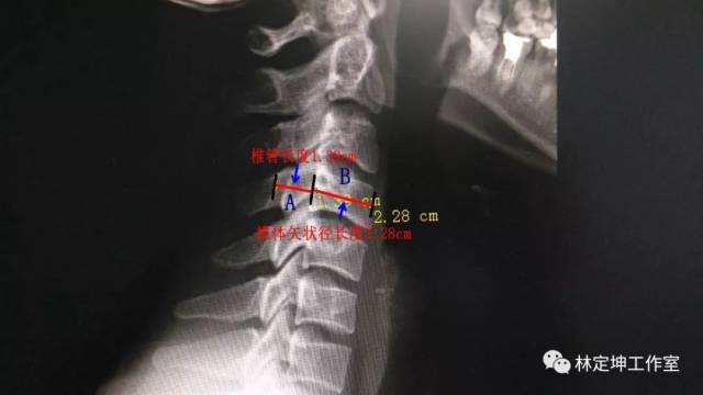 标准x线片下测量椎管和椎体矢状径的长度a/b 0.75