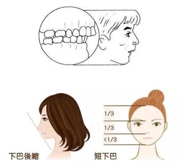 深覆合简单说就是上前牙盖过下前牙牙冠长度1/3以上,或者下前牙咬合于