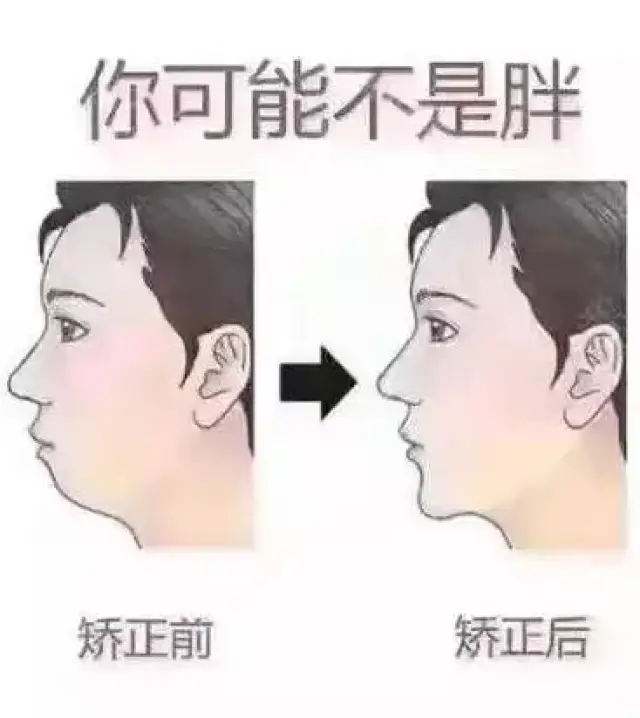 不过 对于牙齿矫正,很多人会担心: …… 牙齿矫正,会改变脸型,是真的