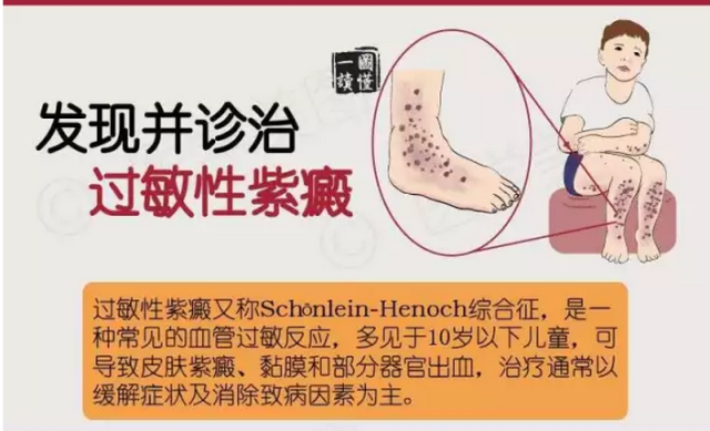 桂生:过敏性紫癜并非是小孩专利,老年人也会得过敏性紫癜