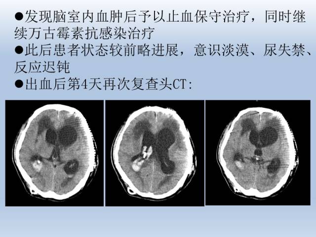 二例脑室-腹腔分流术后迟发分流管周围血肿形成的病例