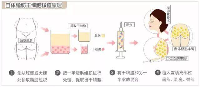 自体脂肪隆胸适用于乳房发育不良,乳房大小不对称和乳房萎缩下垂的mm.