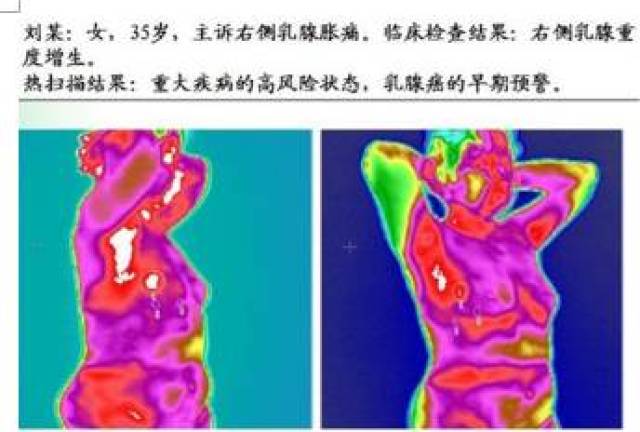 人体热成像检测丨身体晴雨表,疾病早知道