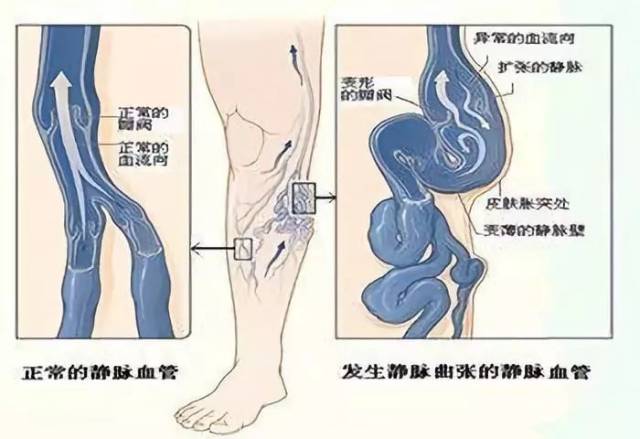 静脉回流受阻,静脉压力增高,这些都是造成下肢静脉曲张的隐患