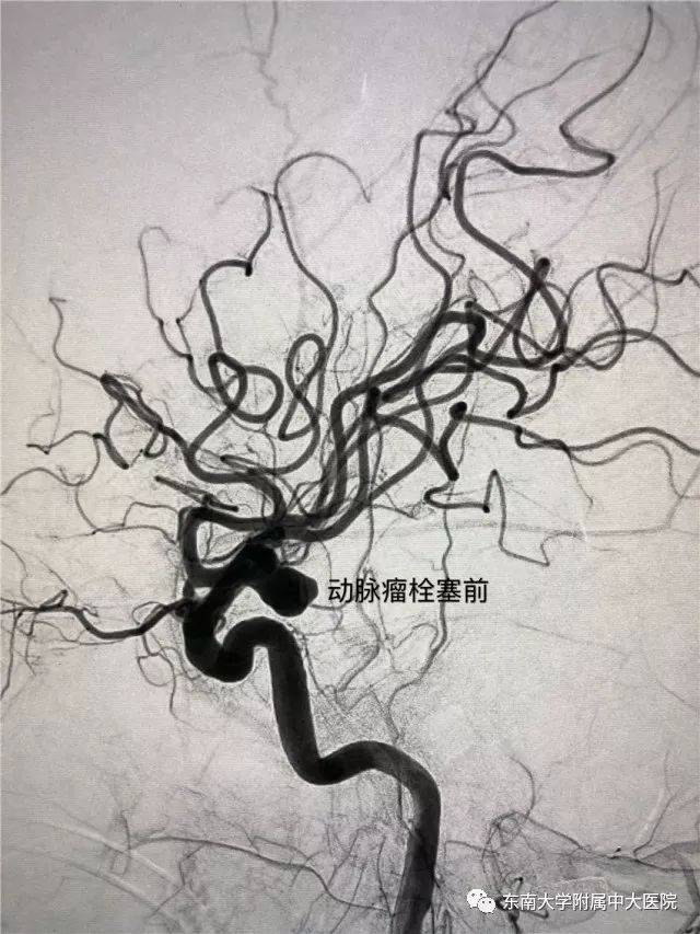 中大医院滕皋军教授团队在国内首创的胃左动脉栓塞减肥新方法,通过