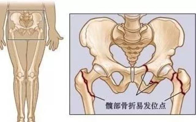 老年髋部骨折的治疗