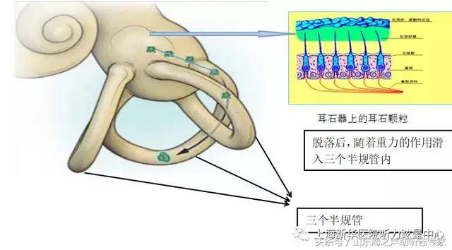 耳石脱落后,为什么体位或头位改变后出现眩晕呢?