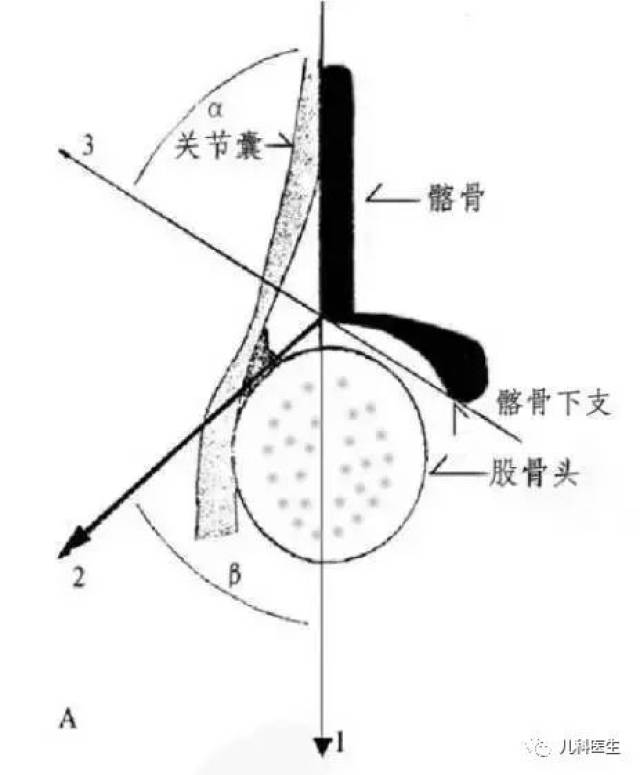 记住α角关键点:小于43度多为脱位髋(iii型,iv型).