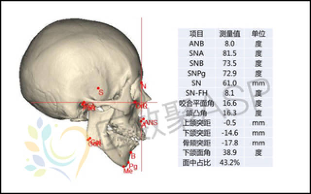 医数聚asp对患者头颅ct进行三维重建并测量相关数据